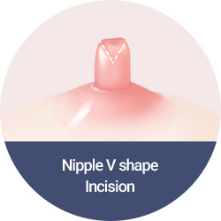 Nipple V shape Incision
